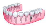 Dental Implant specialist in Fort Worth, TX